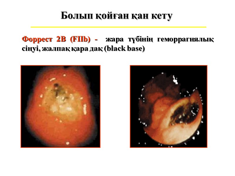 Болып қойған қан кету Форрест 2В (FIIb) -  жара түбінің геморрагиялық сіңуі, жалпақ